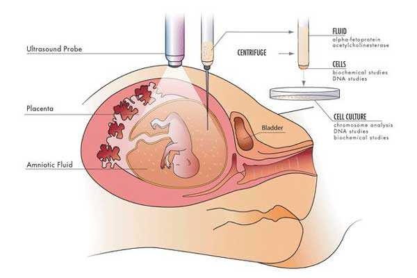 双子宫切除怀孕_宫颈闭锁能怀孕吗_试管婴儿胚胎移植着床失败，来月经时发现