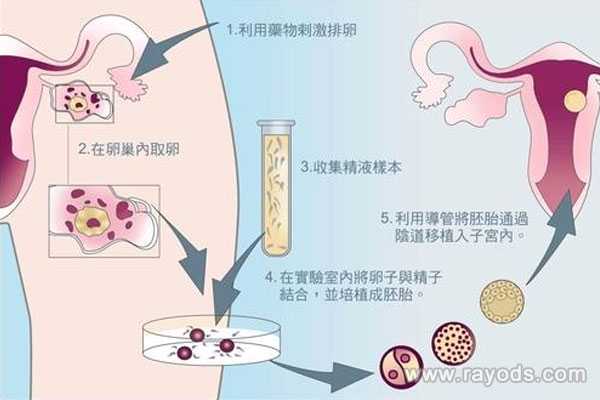 生育后切除子宫_女染色体异常试管_试管婴儿过程是怎样的？有最详细的试管解