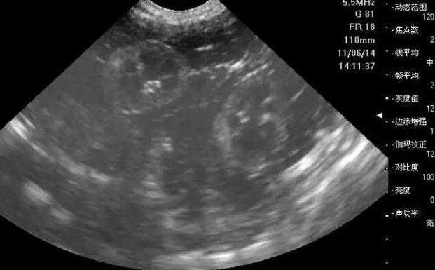 武汉助孕要生孩子吗 2022武汉市第一医院试管婴儿费用明细: ‘孕囊6.1x3.0cm是男